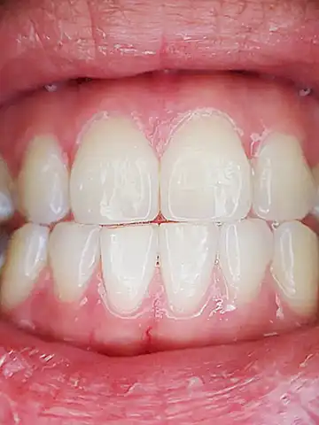 Cómo evitar las infecciones en el dientes y las encías