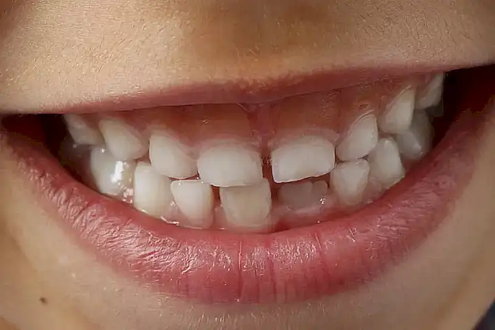 Cómo limpiar los dentes