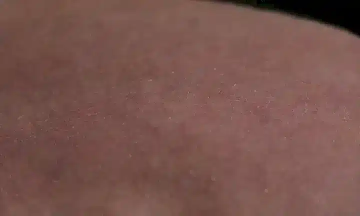 La dermatitis seborreica causa picazón en perros