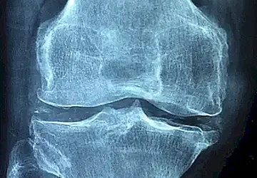 factores-de-riesgo-para-el-dolor-en-las-articulaciones-del-perro_h2_137.webp